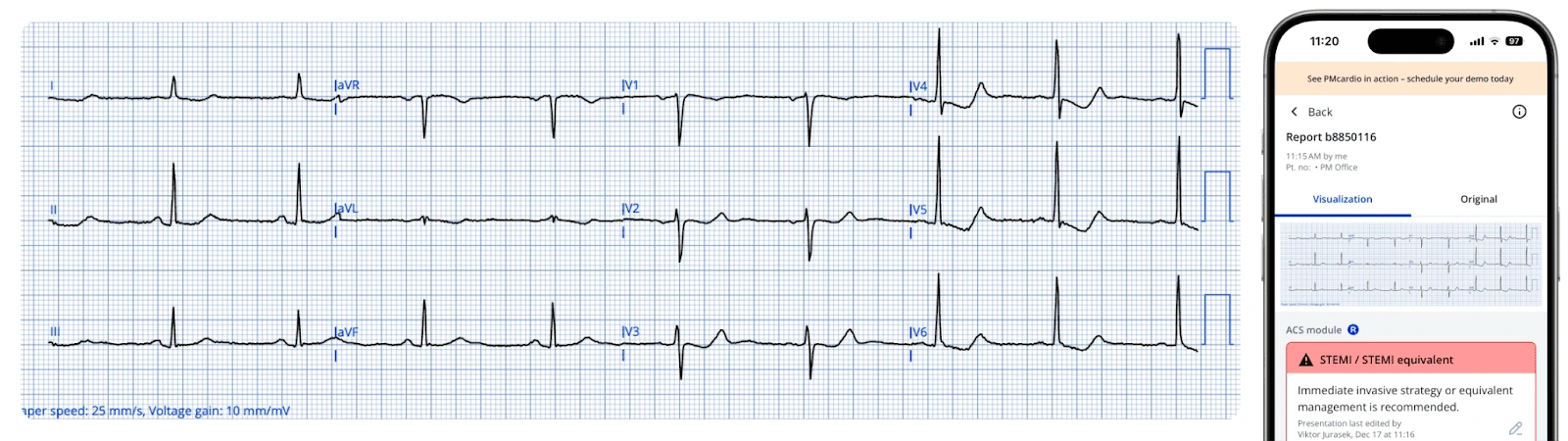 PMcardio digitized ECG and phone still reading STEMI equivalent on the serial ECG during transport