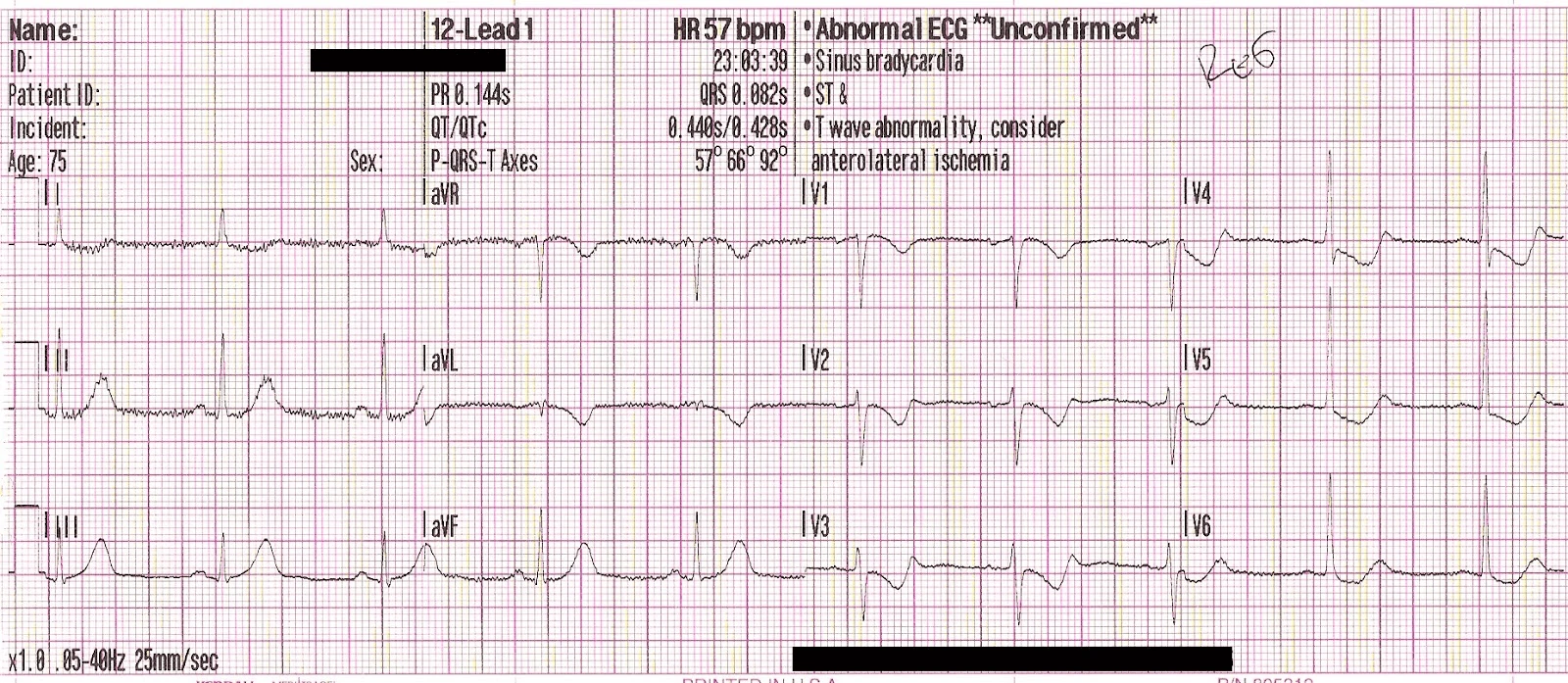 12-lead ECG with hyperacute T-waves in inferior leads and ST depression in V3-V4 indicating posterior occlusion