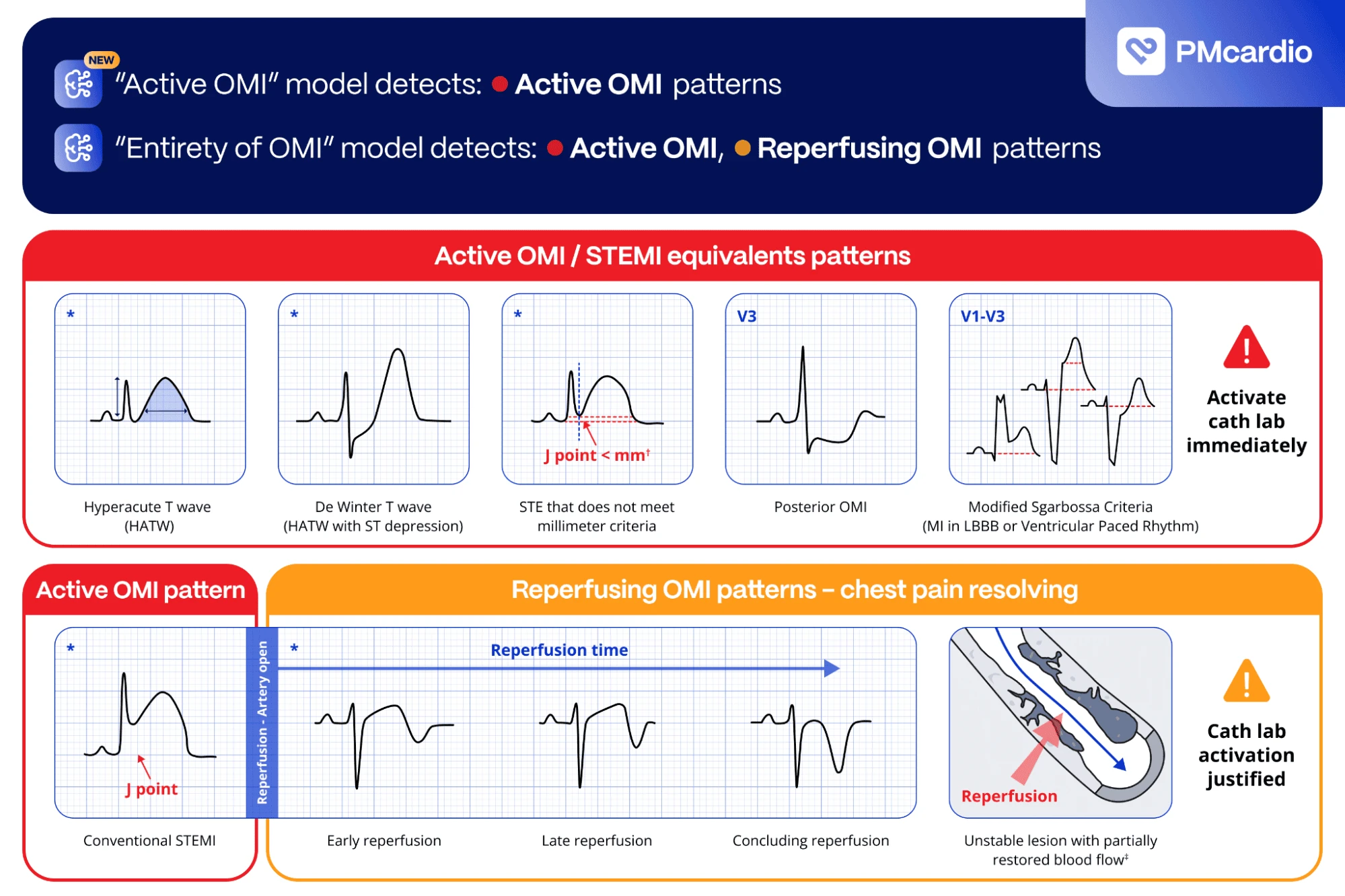 PMcardio chart of Active OMI and STEMI-equivalent ECG patterns versus reperfusing OMI patterns