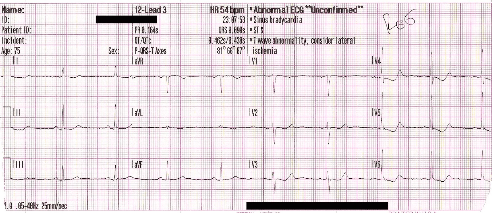 Serial 12-lead ECG showing resolving inferior hyperacute T-waves and improving precordial ST depression
