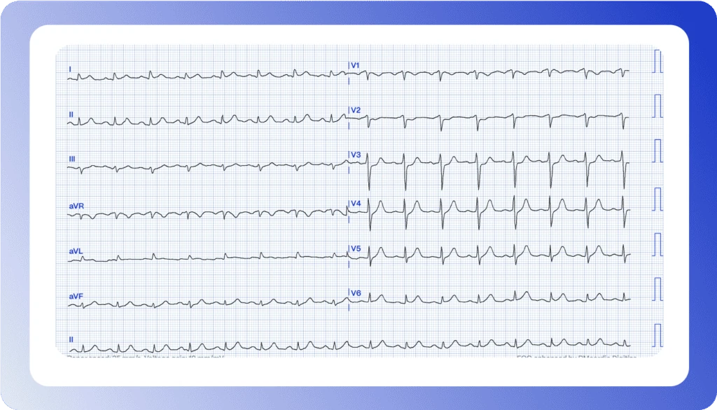 12-lead ECG of a 67-year-old man with two hours of chest pain, digitized by PMcardio, for reader interpretation