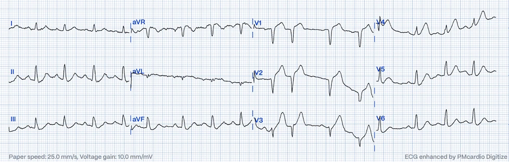 12-lead ECG with hyperacute T-waves in V1-V4, ST elevation in V1-V2 and ST depression indicating LAD occlusion