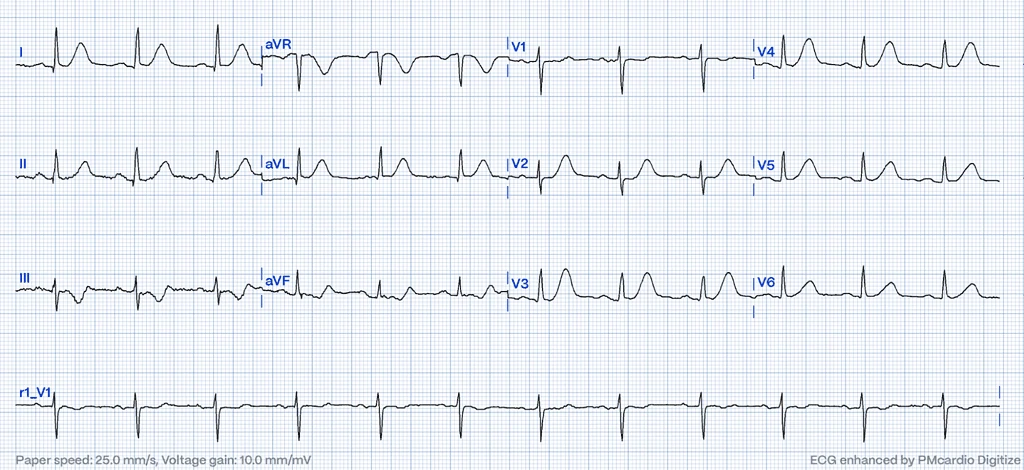 12-lead ECG with large symmetric T-waves in leads I, aVL and V2-V5 diagnostic of proximal LAD occlusion