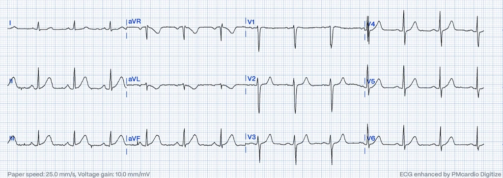 hyperacute T waves with reciprocal negative hyperacute T wave
