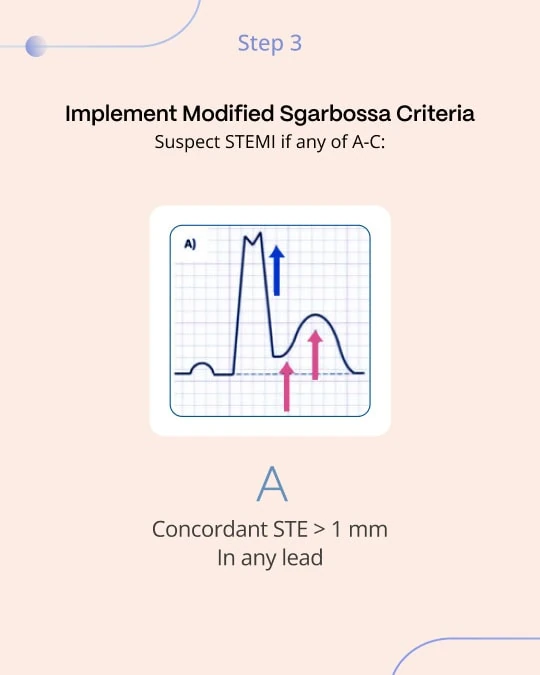 Modified Sgarbossa criterion A: concordant ST elevation over 1 mm in any lead