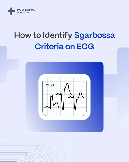 Title card for identifying Sgarbossa criteria on ECG with a stylized V1-V3 waveform