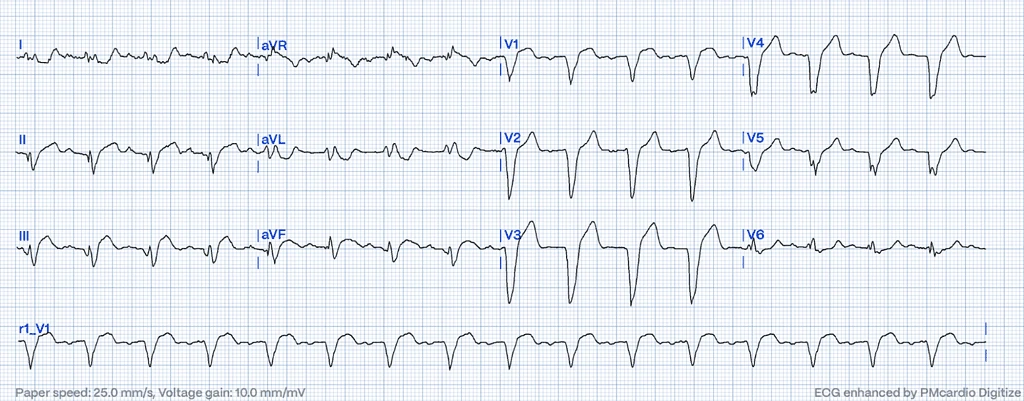 Smith-modified Sgarbossa Criteria on ECG