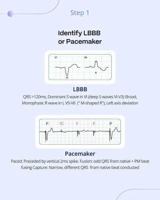 Sgarbossa step 1: identify LBBB or pacemaker using example ECG strips of the QRS features