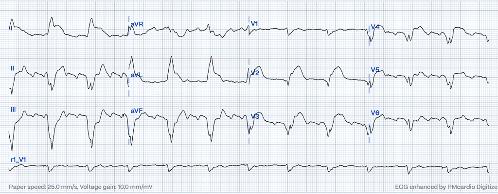 Paced-rhythm 12-lead ECG with concordant ST elevation in I and aVL indicating LAD occlusion MI