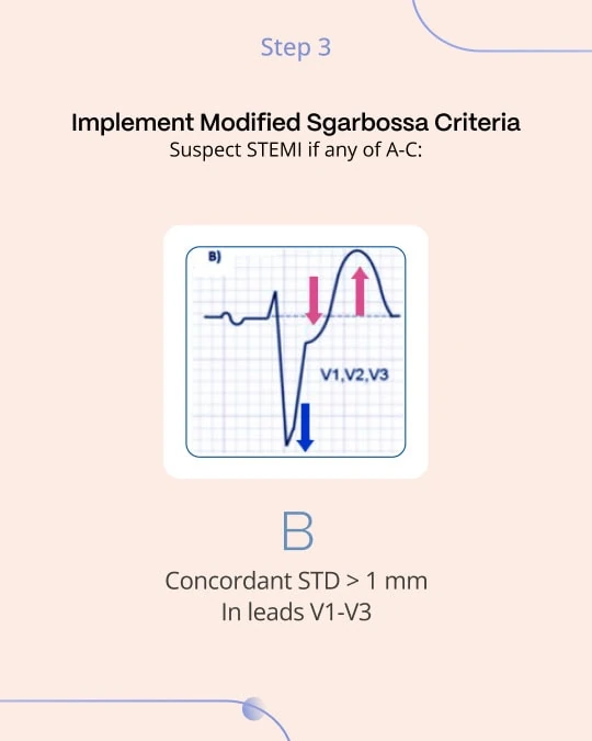 Modified Sgarbossa criterion B: concordant ST depression over 1 mm in leads V1-V3