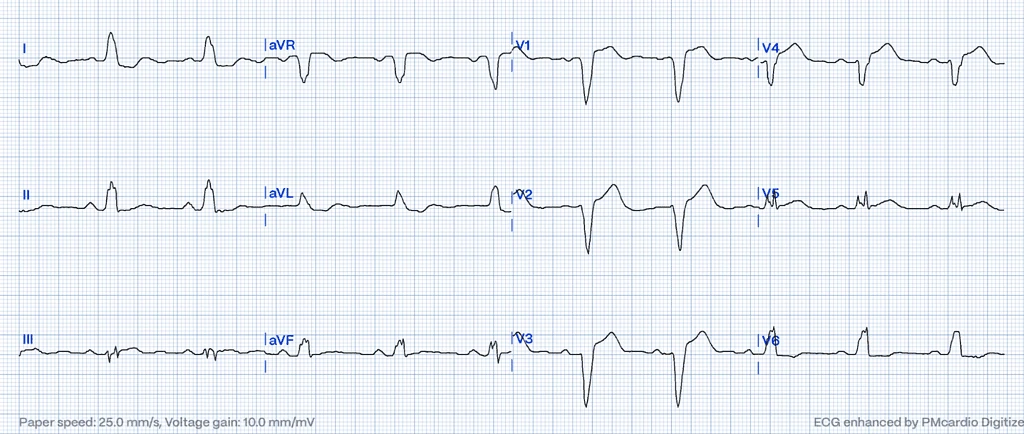 Smith-modified Sgarbossa Criteria on ECG: inus rhythm with LBBB and a ST/S ratio of 0.33 in V4, indicating discordant STE that aligns with the Modified Sgarbossa Criteria.
