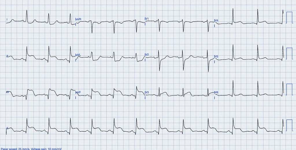 STEMI ECG criteria example of inferior and right ventricular infarct