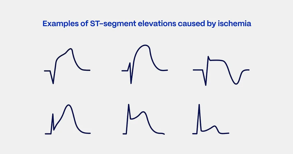 STEMI ECG criteria examples ST-segment elevations caused by ischemia