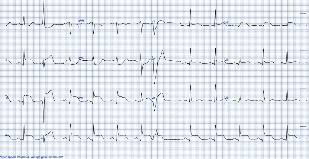 STEMI ECG Criteria Figure: ST-elevation myocardial infarction.