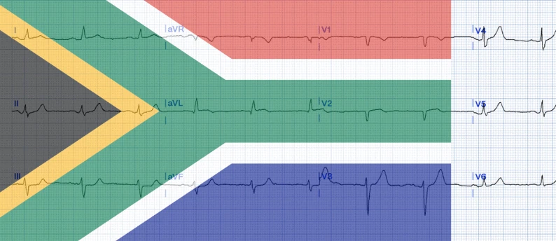 12-lead ECG of South African flag sign with ST elevation in I, aVL and V2 and reciprocal inferior ST depression