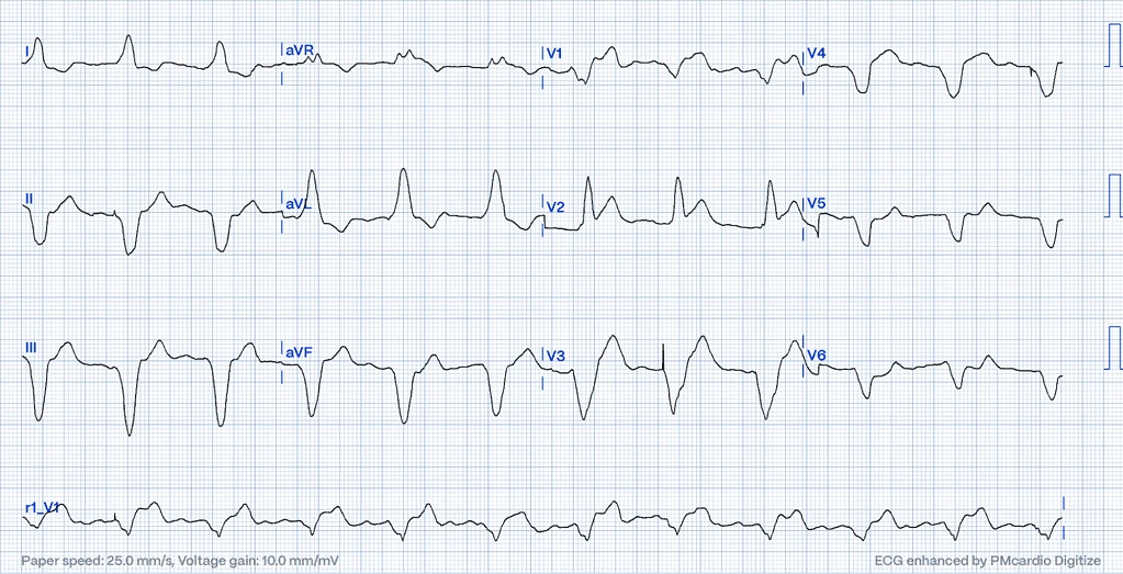 ECG - concordant ST elevation in V2, proportionally excessively discordant STE in V3 and concordant ST depression in V6 (Dr.Smith's ECG Blog, digitized by PMcardio)
