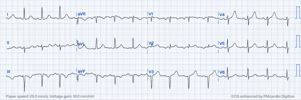 STEMI Equivalents: Hyperacute T-waves in V4