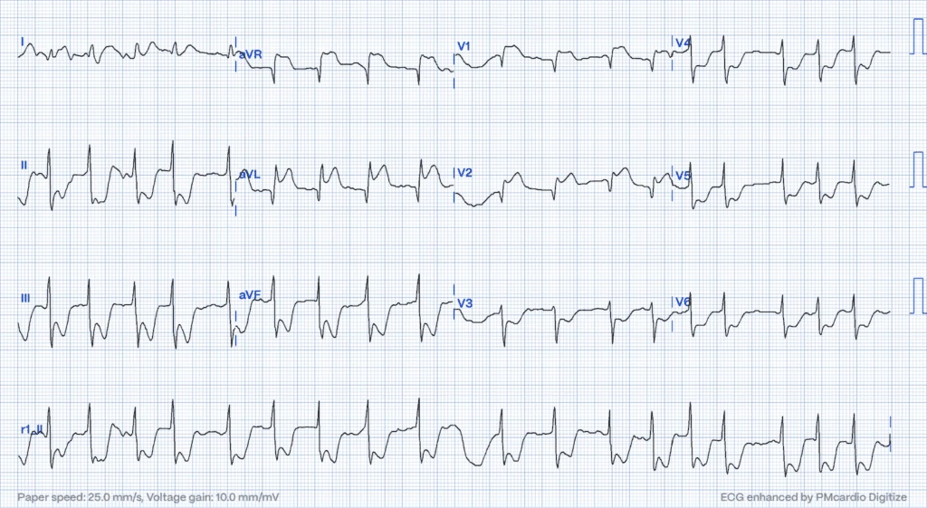 Posterior MI: ST Elevation in aVR