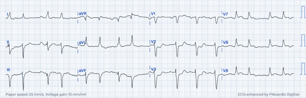 STEMI Equivalents: Posterior MI