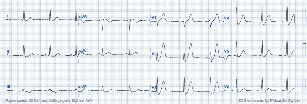STEMI Equivalents: ECG - De Winter's T-waves