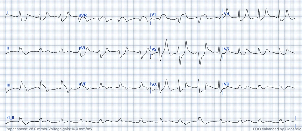 12-lead ECG with wide QRS junctional rhythm and peaked T-waves from hyperkalemia mimicking STEMI