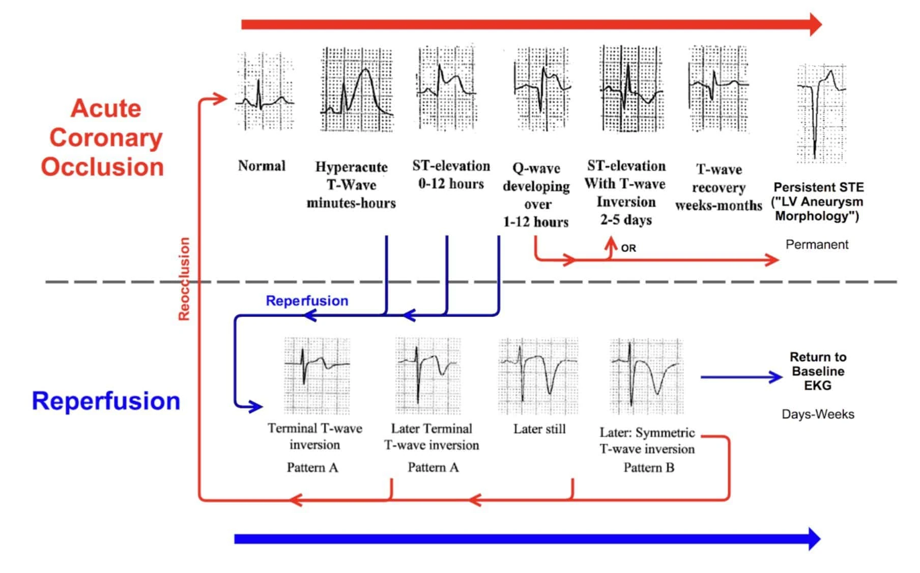 Occlusion Myocardial Infarction (OMI) Dynamic ECG changes of acute coronary occlusion.