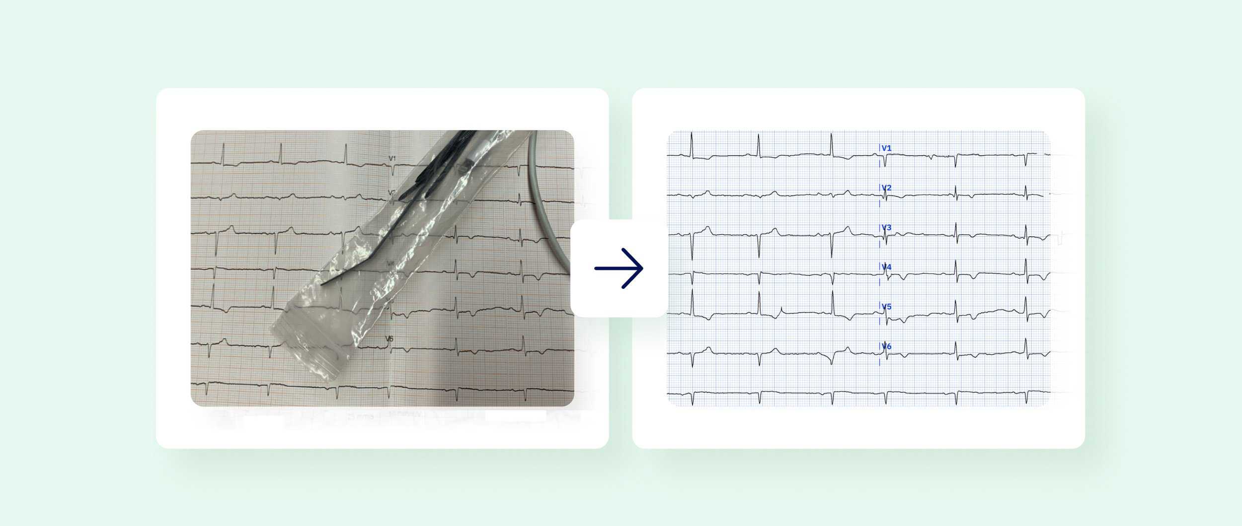 An image of an obstructed, poor-quality ECG and next to it a corrected ECG recording digitized by PMcardio