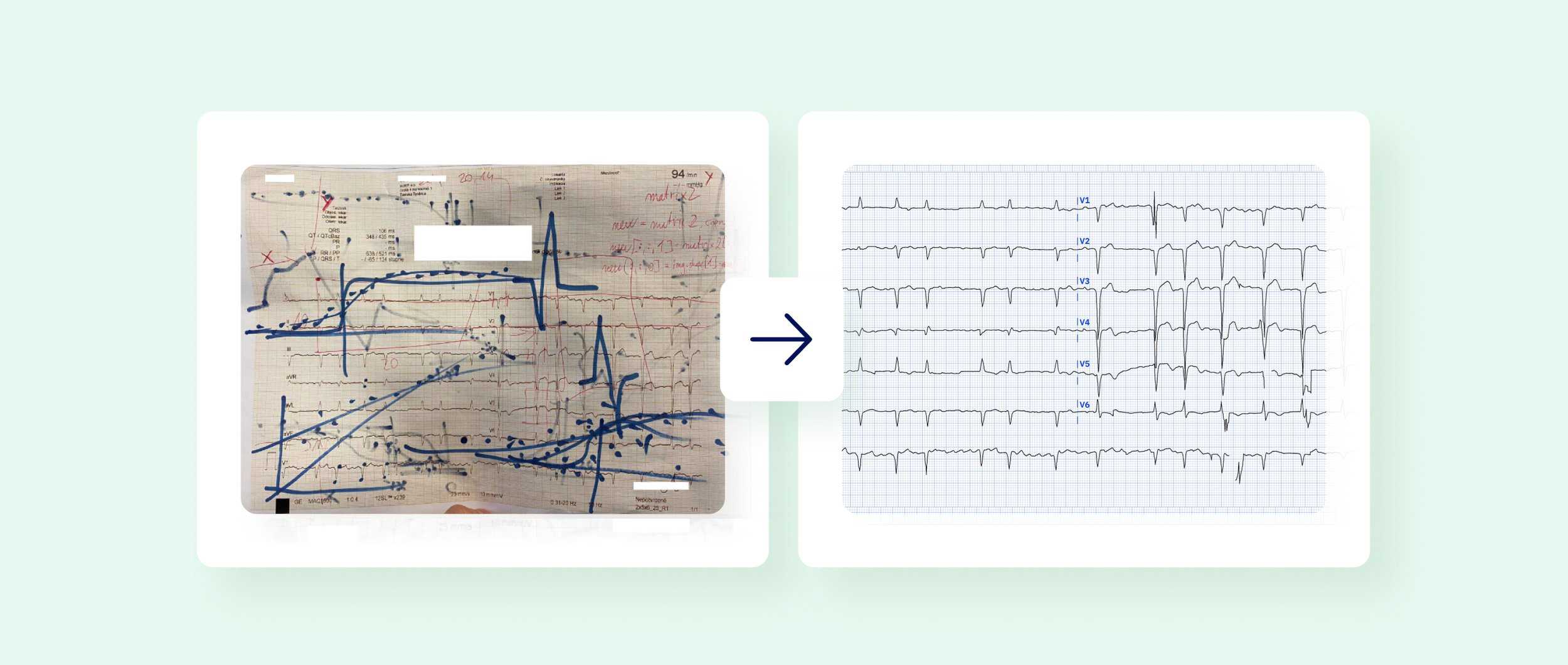 An image of a scribbled over poor-quality ECG and next to it a corrected ECG recording digitized by PMcardio
