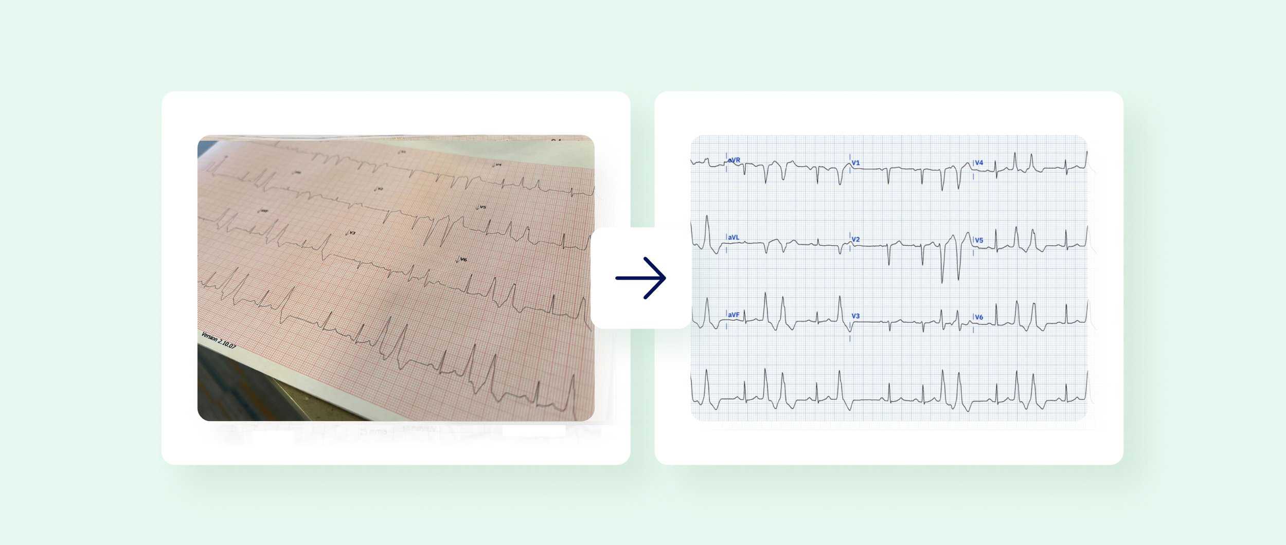 An image of a poor-quality ECG taken from an awkward angle and next to it a corrected ECG recording digitized by PMcardio