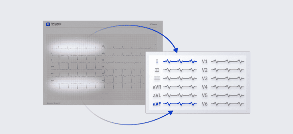 An image of PMcardio's ECG format icon matched to the real ECG tracing