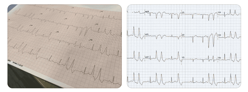 An image of an ECG taken from a wrong angle versus a digitized, straightened out version of the same ECG enhanced by PMcardio