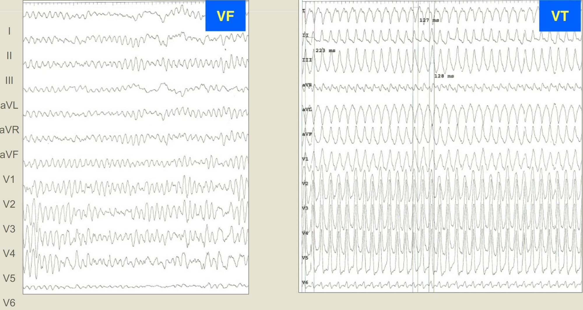 Two sample ECGs, one depicting ventricular fibrillation, the other depicting ventricular tachycardia