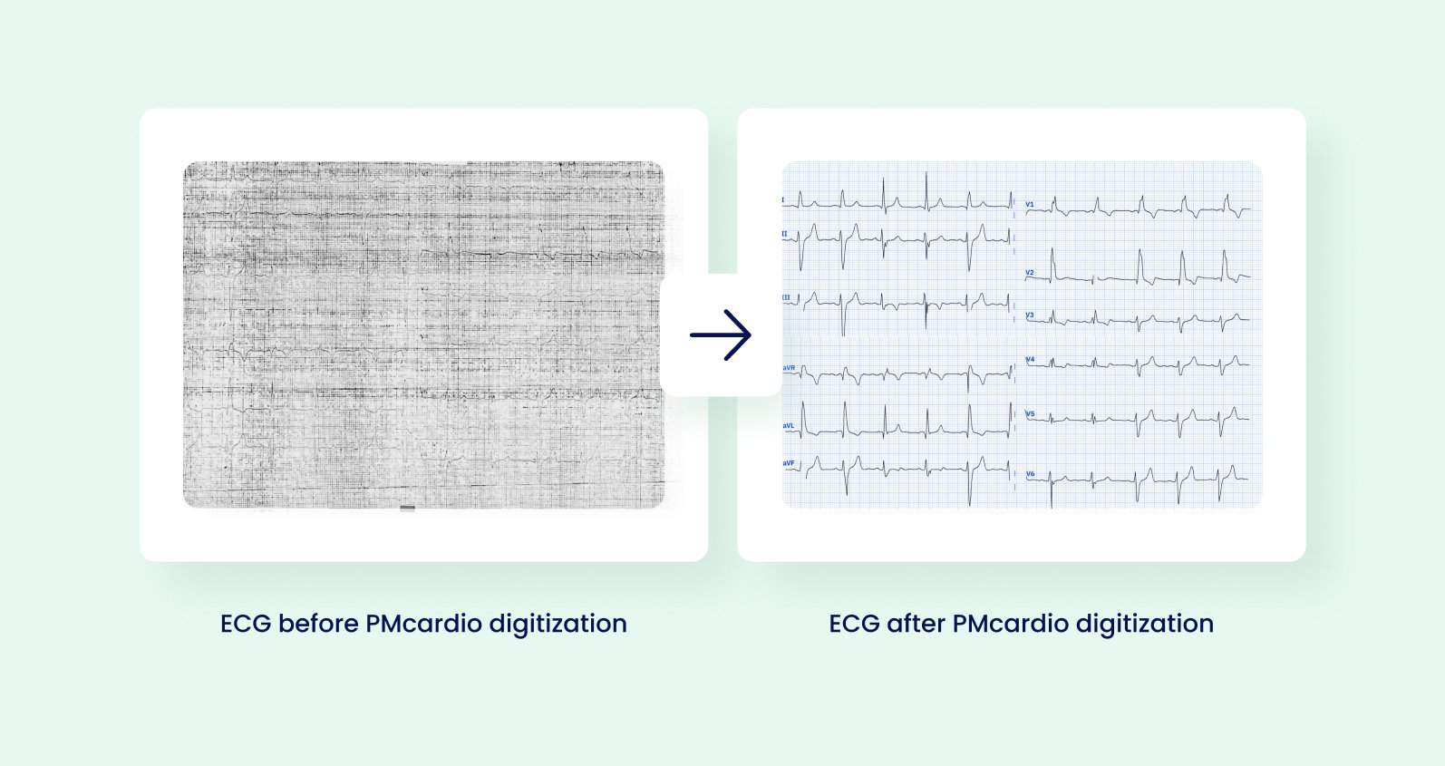 An image of an old, poor-quality ECG versus a digitized, straightened out ECG image enhanced by PMcardio