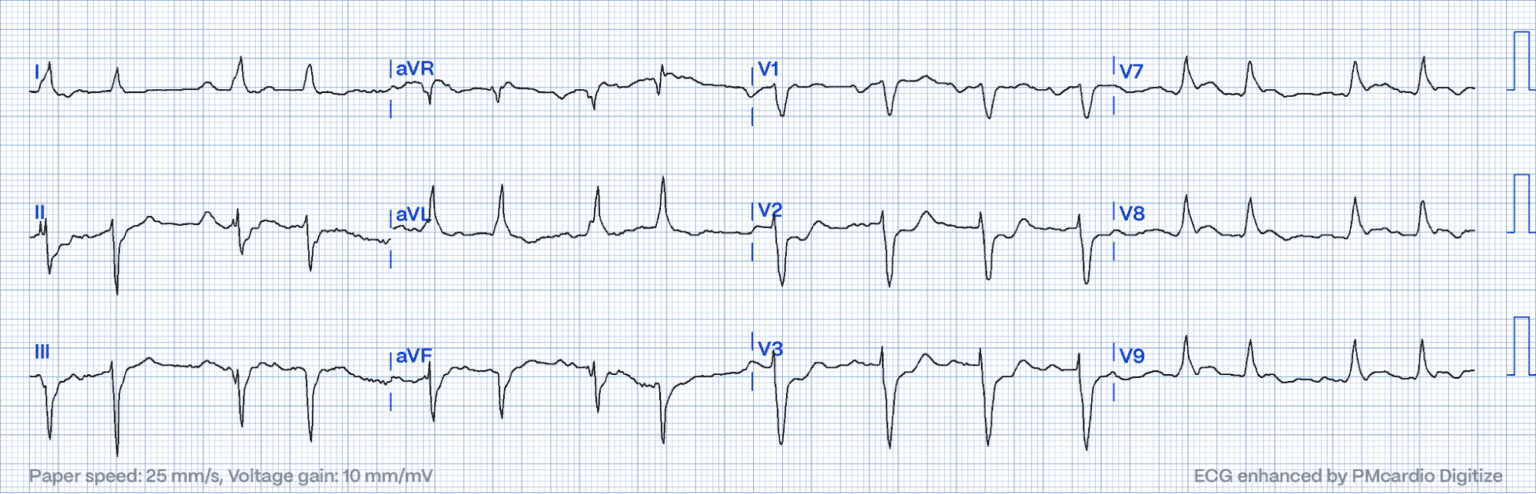 STEMI Equivalents: Navigating The Hidden | PMcardio