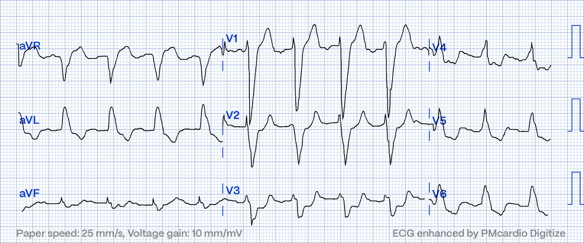 STEMI Equivalents: Navigating The Hidden | PMcardio