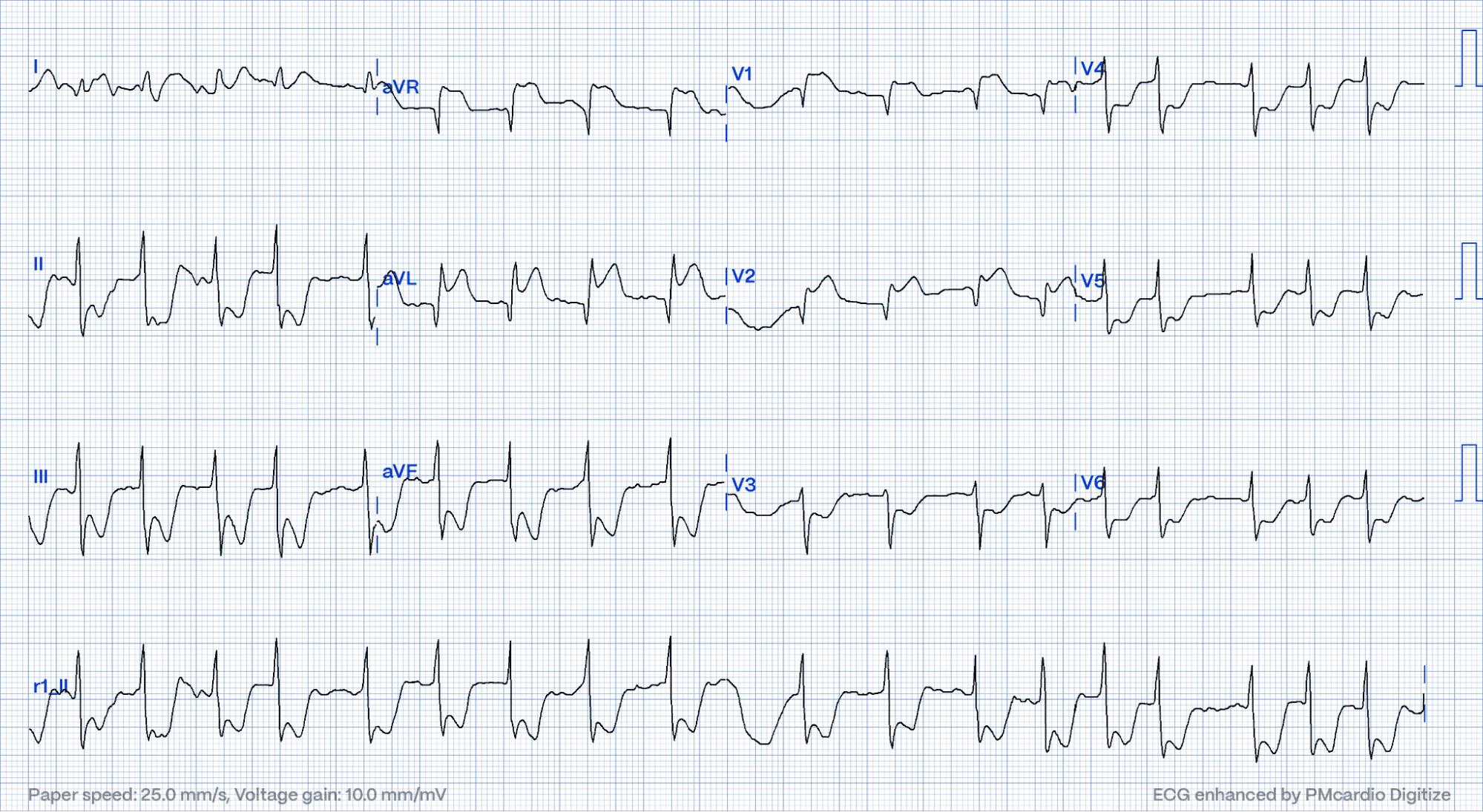 STEMI Equivalents: Navigating The Hidden | PMcardio