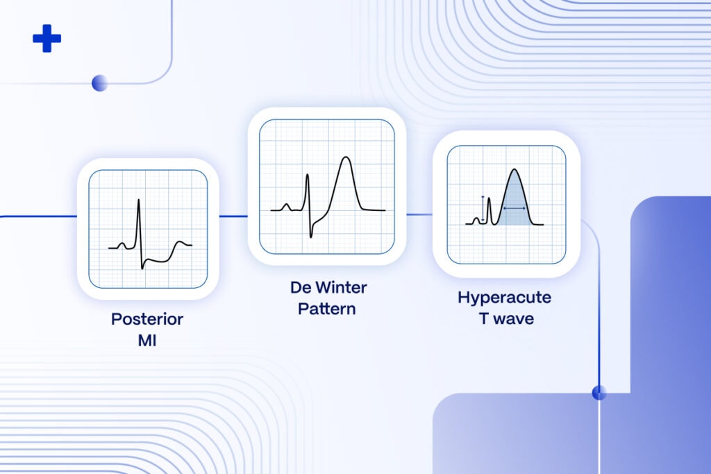 STEMI Equivalents: Navigating The Hidden | PMcardio