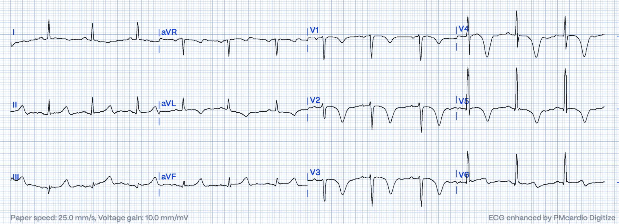 Wellens' Syndrome: How to Prevent Acute Coronary Occlusions