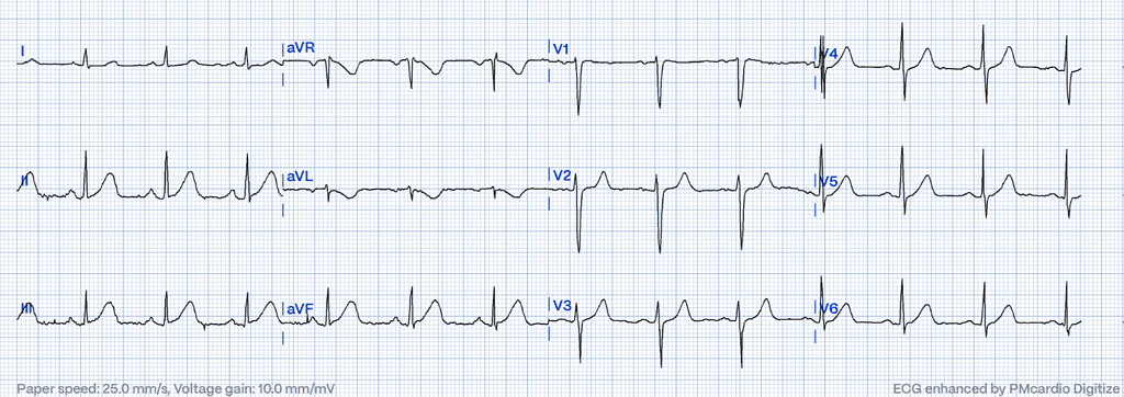  hyperacute T waves with reciprocal negative hyperacute T wave