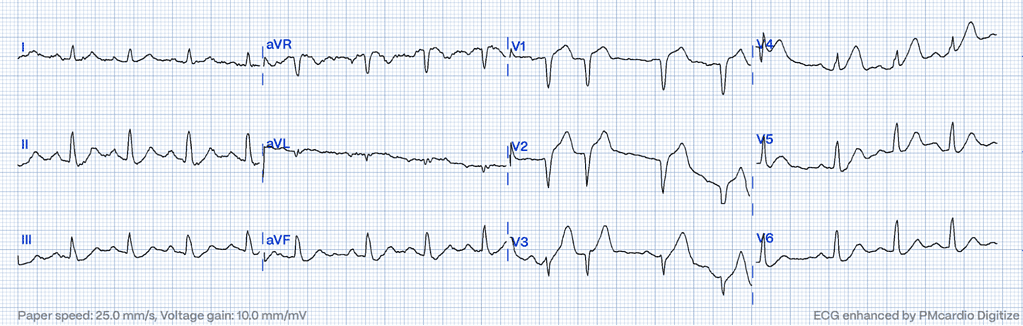 Hyperacute T-Waves: A Comprehensive Pattern Exploration