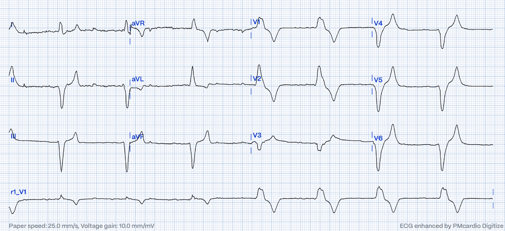 Hyperacute T-Waves: A Comprehensive Pattern Exploration