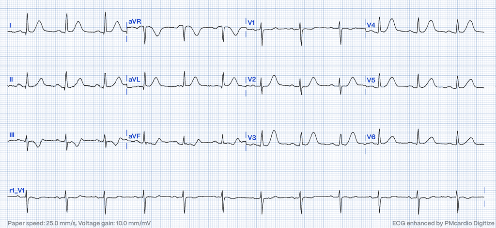 Hyperacute T-Waves: A Comprehensive Pattern Exploration