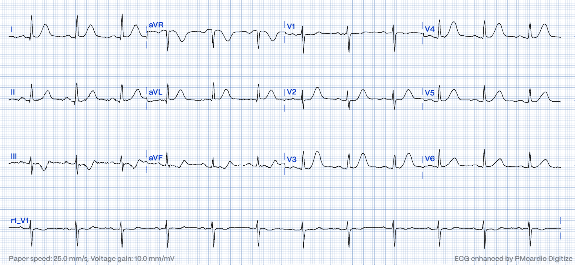 Hyperacute T-waves: A Comprehensive Pattern Exploration