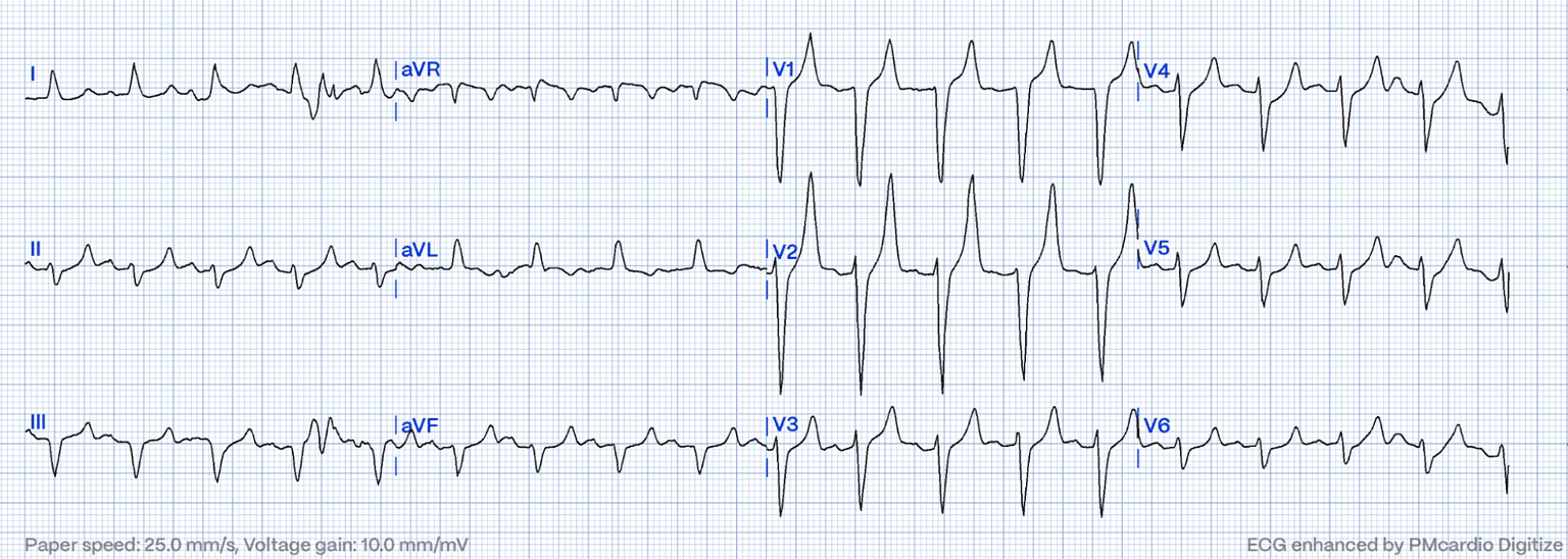 Hyperacute T-Waves: A Comprehensive Pattern Exploration