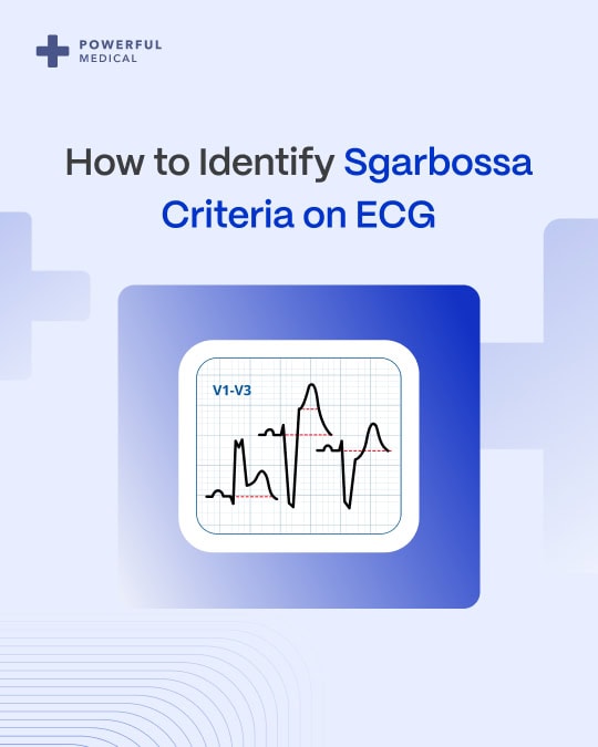 Sgarbossa Criteria: A Gateway to Advanced Cardiac Diagnosis