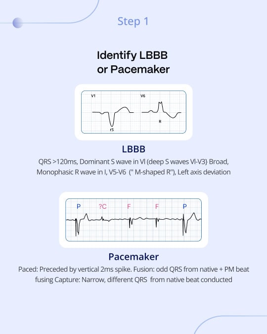 Sgarbossa Criteria: A Gateway to Advanced Cardiac Diagnosis