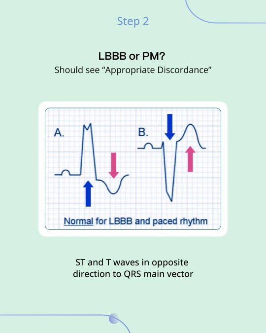 Sgarbossa Criteria: A Gateway to Advanced Cardiac Diagnosis