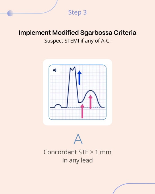 Sgarbossa Criteria: A Gateway to Advanced Cardiac Diagnosis