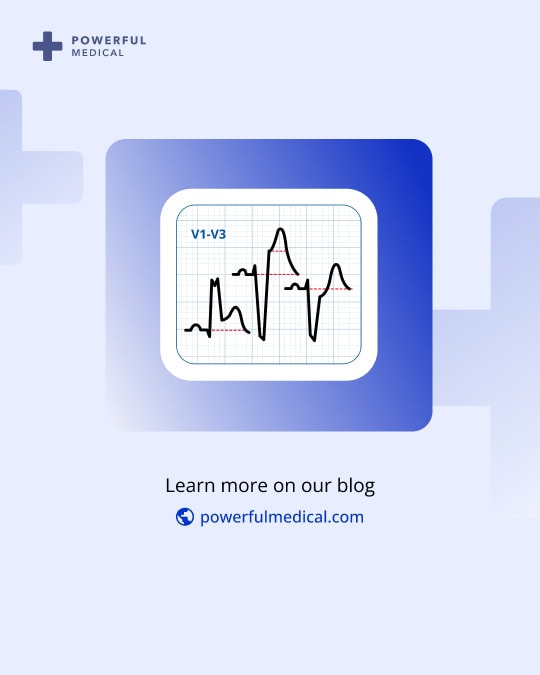 Sgarbossa Criteria: A Gateway to Advanced Cardiac Diagnosis