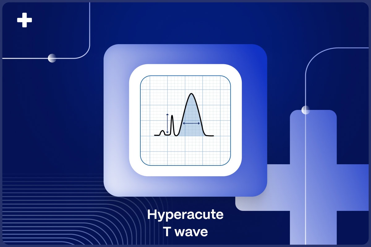 Hyperacute T-Waves: A Comprehensive Exploration